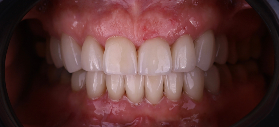 قشور الأسنان2