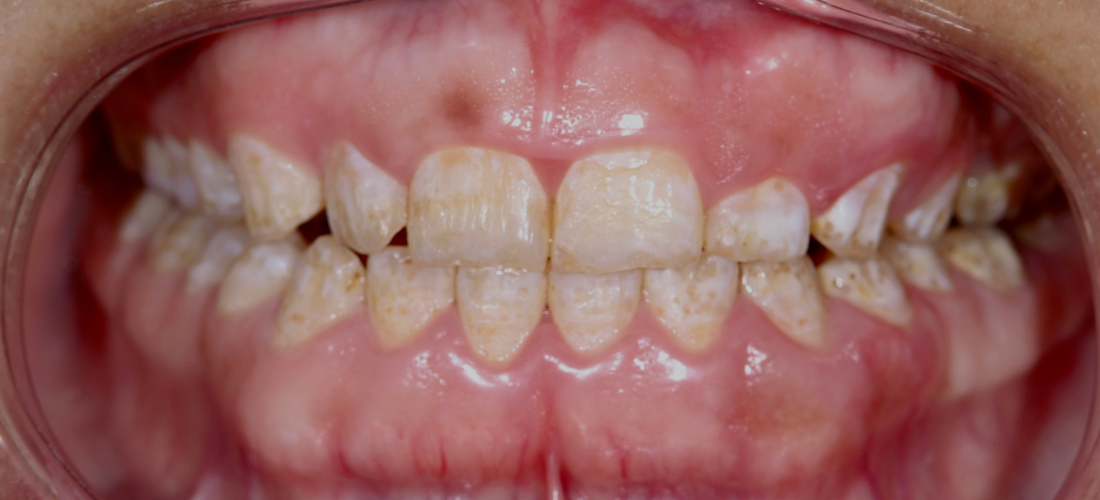 إطالة التاج